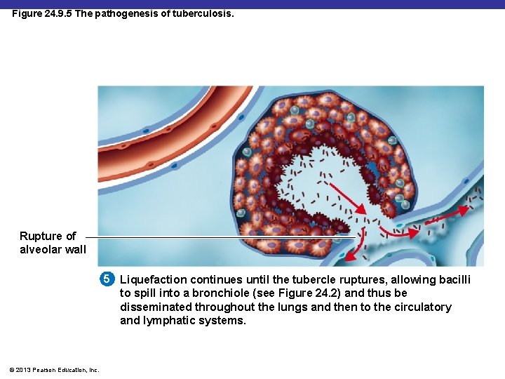 Figure 24. 9. 5 The pathogenesis of tuberculosis. Rupture of alveolar wall 5 Liquefaction