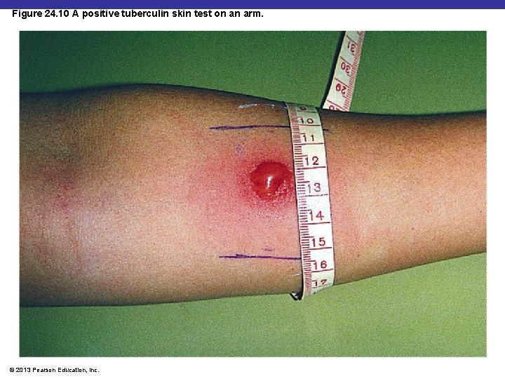 Figure 24. 10 A positive tuberculin skin test on an arm. © 2013 Pearson