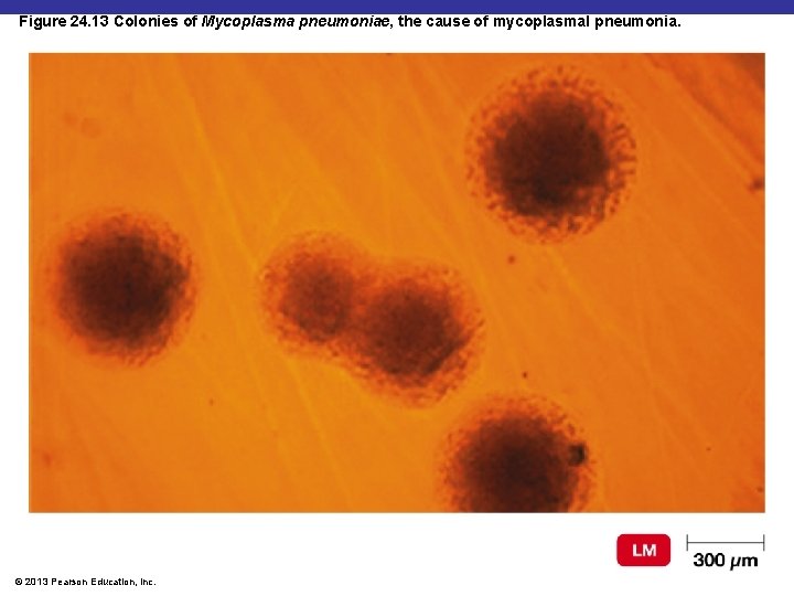 Figure 24. 13 Colonies of Mycoplasma pneumoniae, the cause of mycoplasmal pneumonia. © 2013