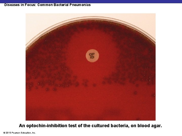 Diseases in Focus: Common Bacterial Pneumonias An optochin-inhibition test of the cultured bacteria, on