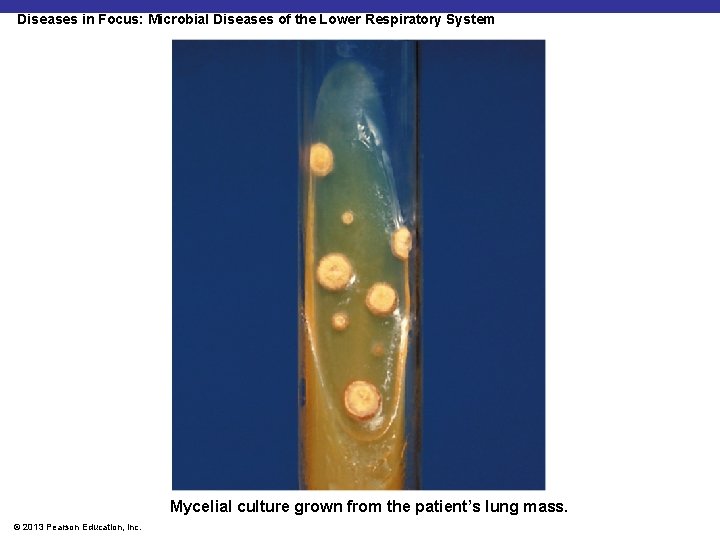 Diseases in Focus: Microbial Diseases of the Lower Respiratory System Mycelial culture grown from