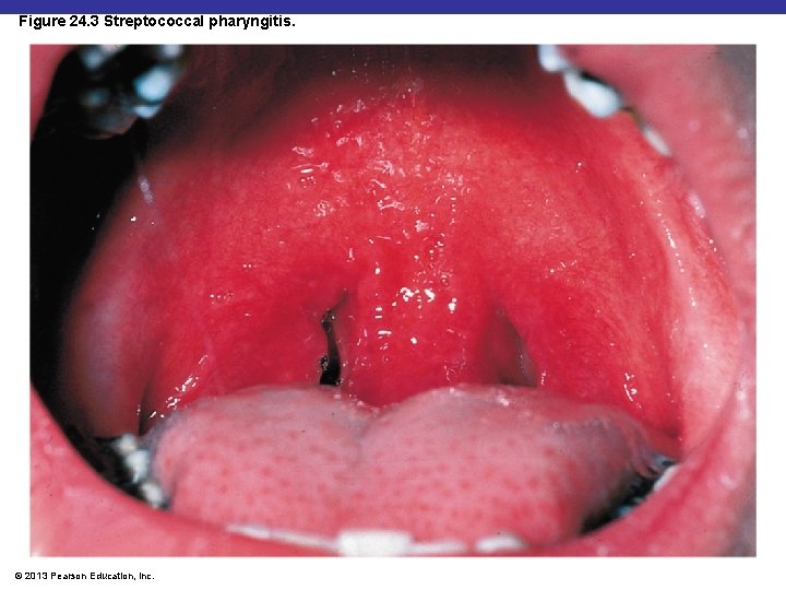 Figure 24. 3 Streptococcal pharyngitis. © 2013 Pearson Education, Inc. 