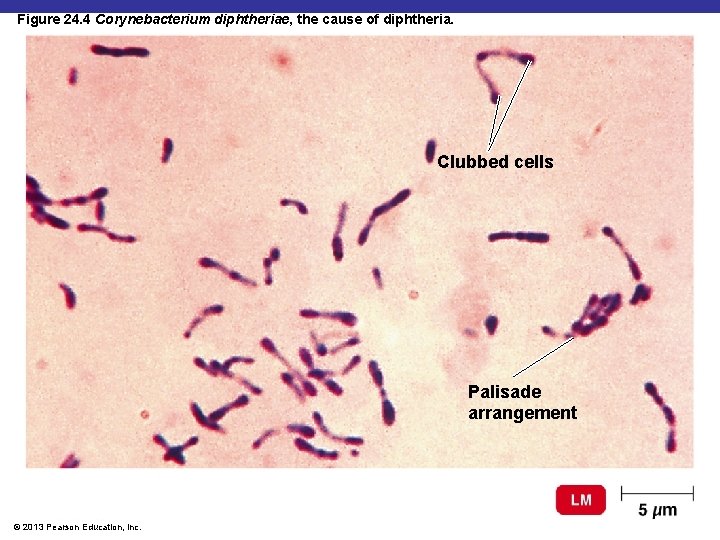 Figure 24. 4 Corynebacterium diphtheriae, the cause of diphtheria. Clubbed cells Palisade arrangement ©