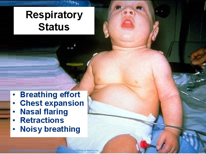 Respiratory Status • • • Breathing effort Chest expansion Nasal flaring Retractions Noisy breathing