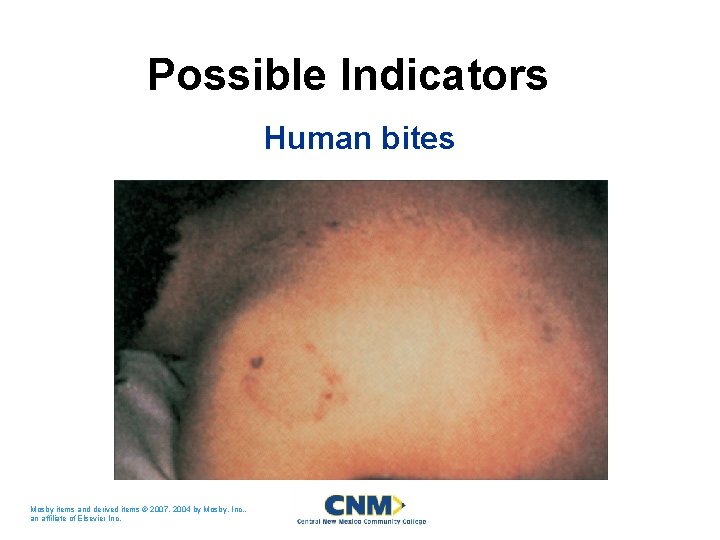 Possible Indicators Human bites Mosby items and derived items © 2007, 2004 by Mosby,