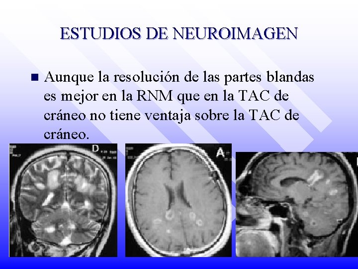 ESTUDIOS DE NEUROIMAGEN n Aunque la resolución de las partes blandas es mejor en