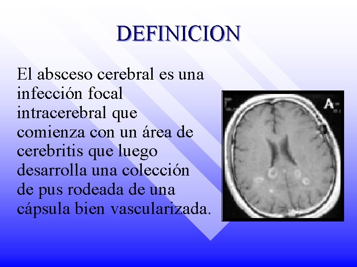 DEFINICION El absceso cerebral es una infección focal intracerebral que comienza con un área