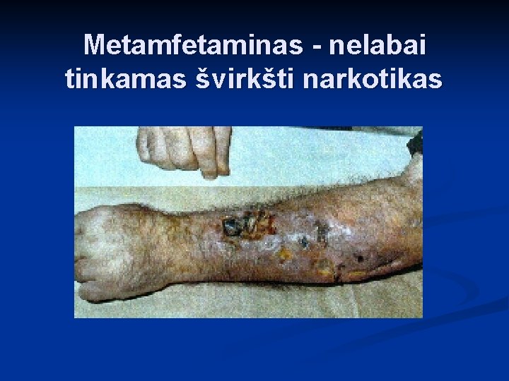 Metamfetaminas - nelabai tinkamas švirkšti narkotikas 