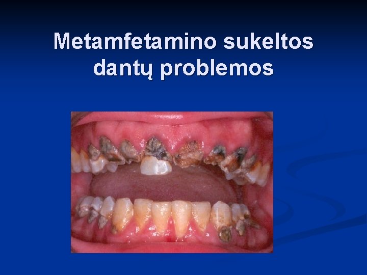Metamfetamino sukeltos dantų problemos 