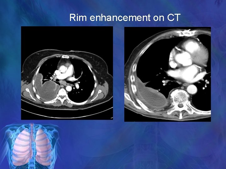 Rim enhancement on CT 