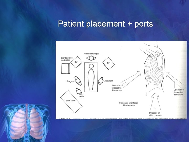 Patient placement + ports 