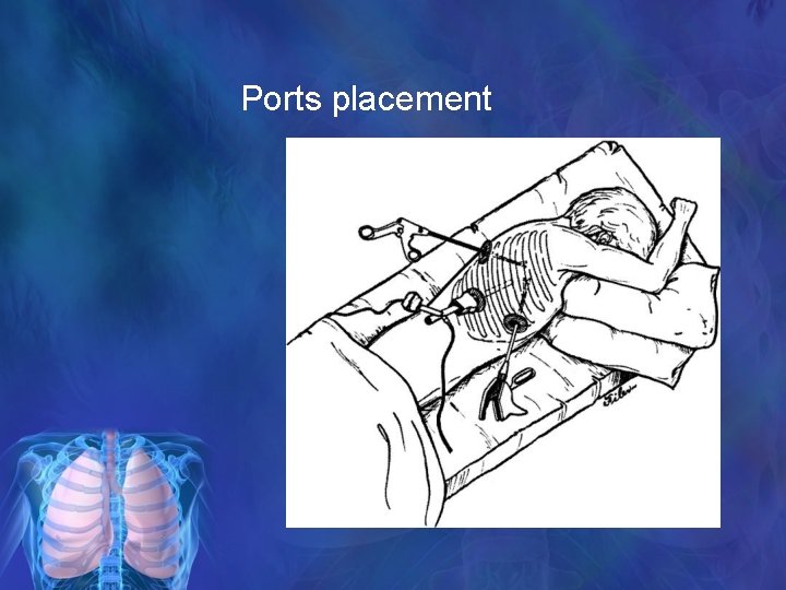 Ports placement 