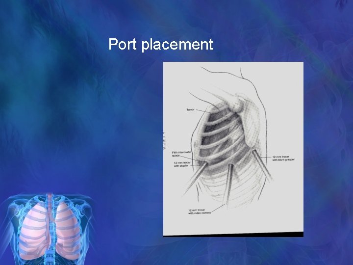 Port placement 