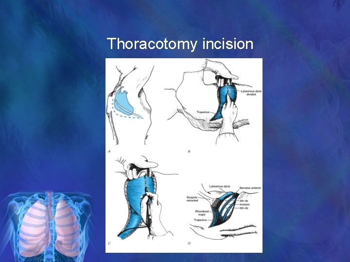 Thoracotomy incision 