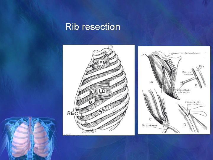 Rib resection 