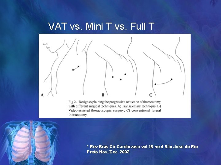 VAT vs. Mini T vs. Full T * Rev Bras Cir Cardiovasc vol. 18