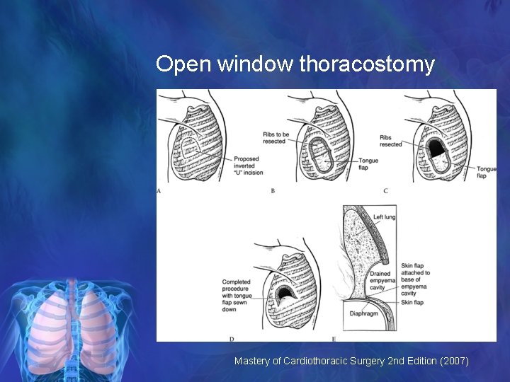 Open window thoracostomy Mastery of Cardiothoracic Surgery 2 nd Edition (2007) 