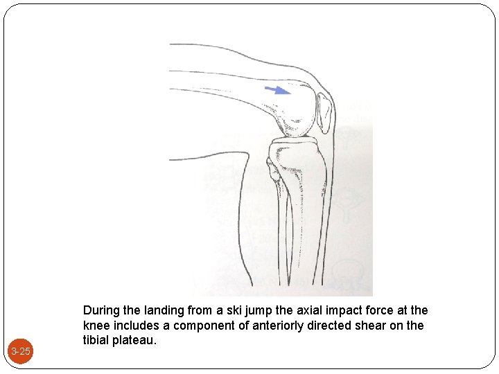 3 -25 During the landing from a ski jump the axial impact force at