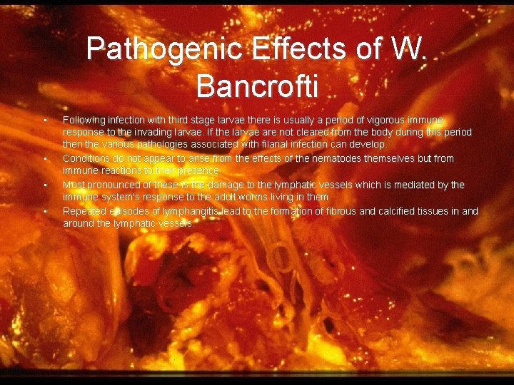 Pathogenic Effects of W. Bancrofti • • Following infection with third stage larvae there