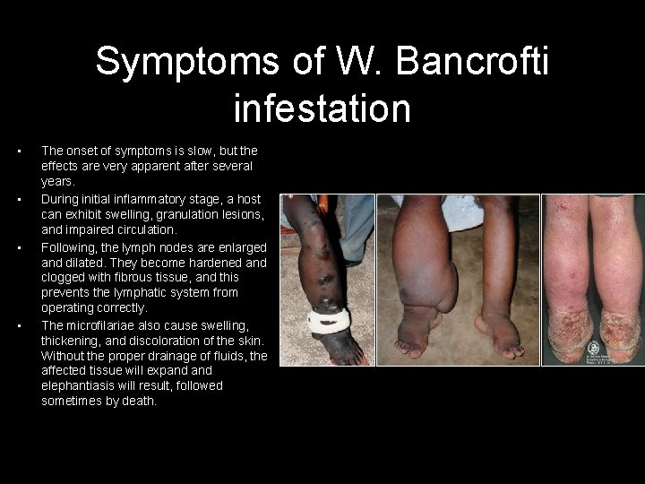 Symptoms of W. Bancrofti infestation • • The onset of symptoms is slow, but