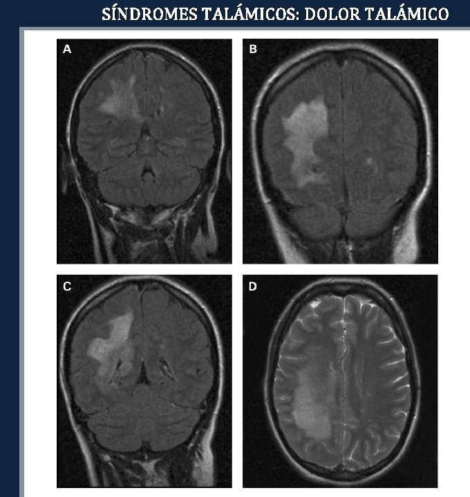 SÍNDROMES TALÁMICOS: DOLOR TALÁMICO 