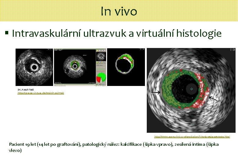 In vivo § Intravaskulární ultrazvuk a virtuální histologie Dr. Arash Taki http: //campar. in.