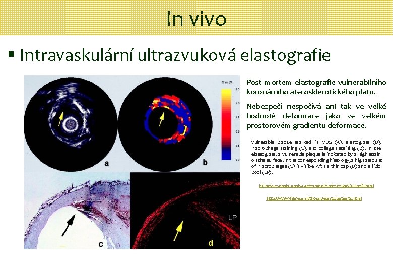 In vivo § Intravaskulární ultrazvuková elastografie Post mortem elastografie vulnerabilního koronárního aterosklerotického plátu. Nebezpečí