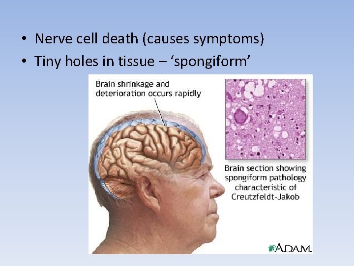  • Nerve cell death (causes symptoms) • Tiny holes in tissue – ‘spongiform’