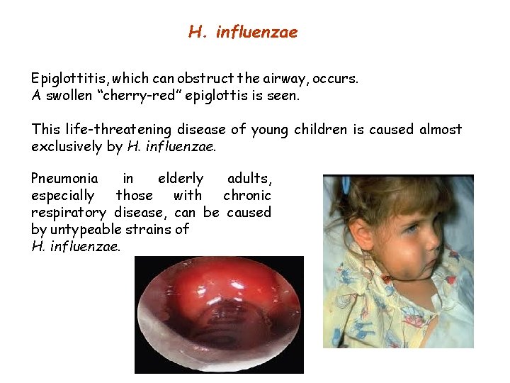 H. influenzae Epiglottitis, which can obstruct the airway, occurs. A swollen “cherry-red” epiglottis is