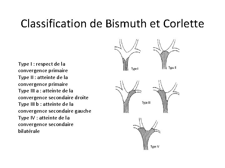 Classification de Bismuth et Corlette Type I : respect de la convergence primaire Type