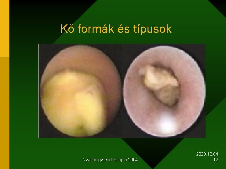 Kő formák és típusok Nyálmirigy-endoscopia 2004 2020. 12. 04. 12 