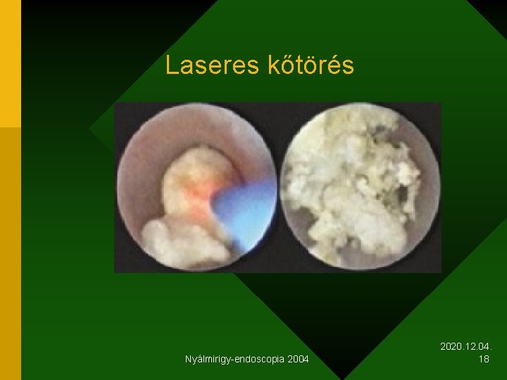 Laseres kőtörés Nyálmirigy-endoscopia 2004 2020. 12. 04. 18 