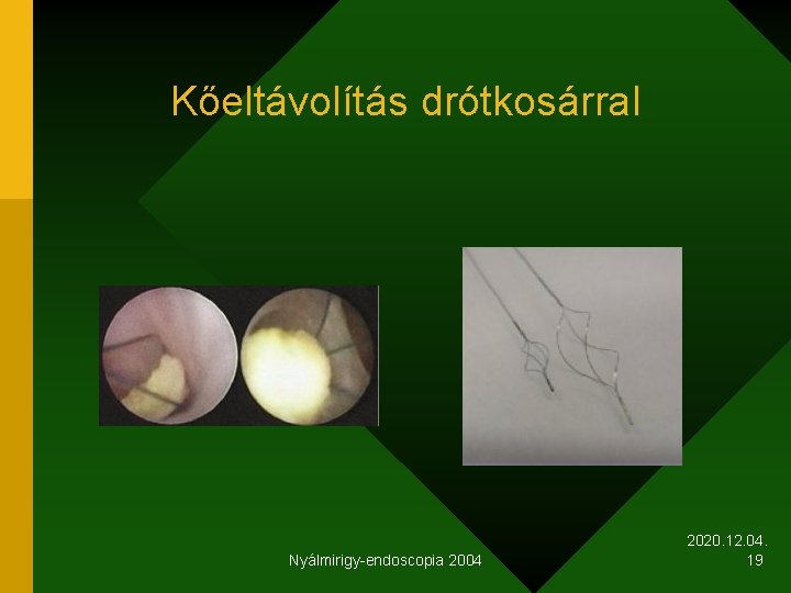 Kőeltávolítás drótkosárral Nyálmirigy-endoscopia 2004 2020. 12. 04. 19 