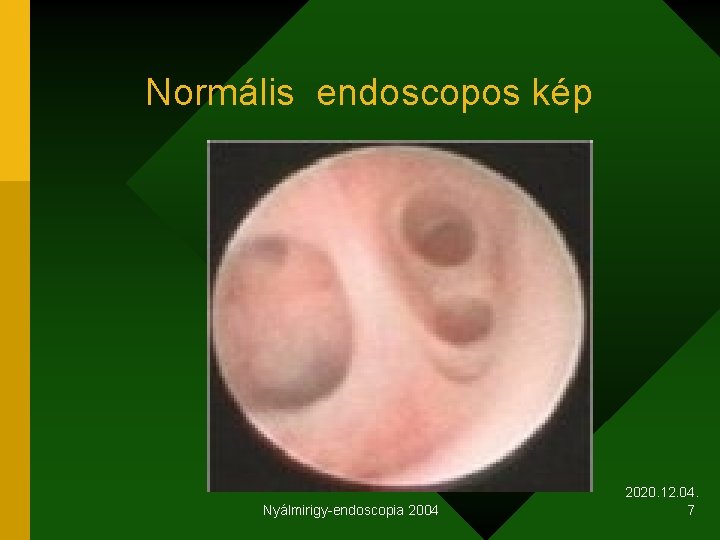 Normális endoscopos kép Nyálmirigy-endoscopia 2004 2020. 12. 04. 7 