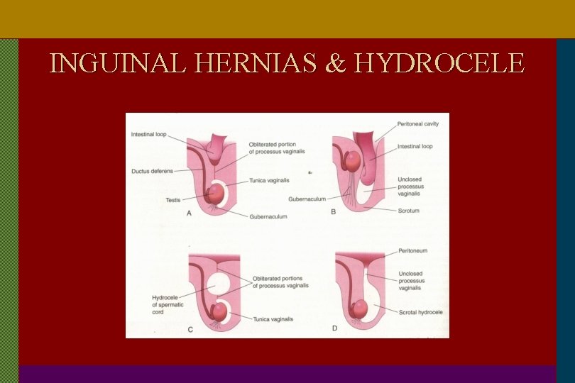 INGUINAL HERNIAS & HYDROCELE 