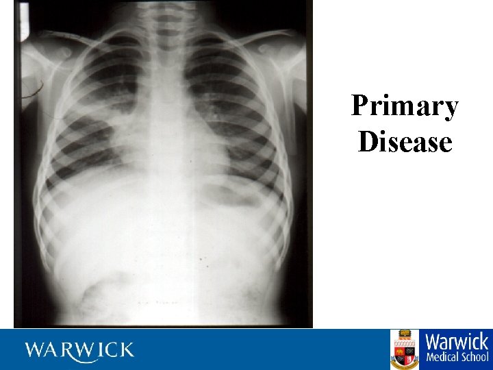 Primary Disease 