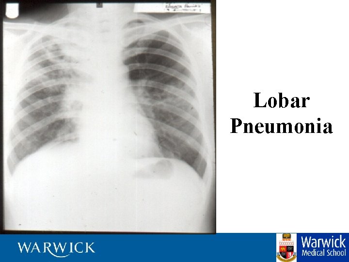 Lobar Pneumonia 