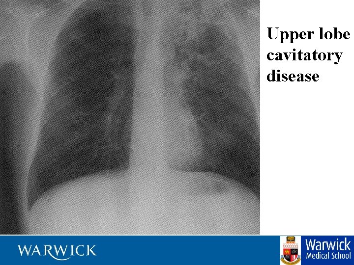 Upper lobe cavitatory disease 