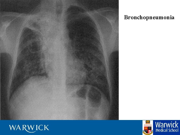 Bronchopneumonia 