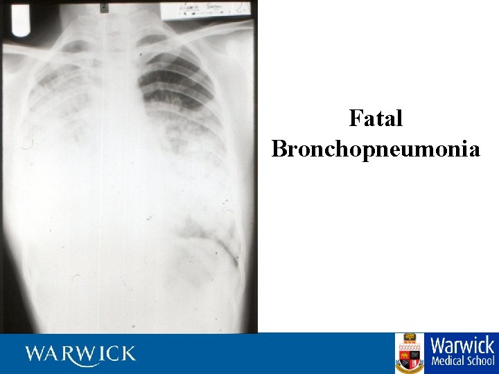 Fatal Bronchopneumonia 