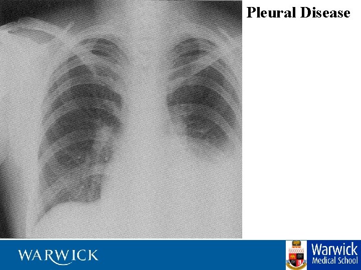 Pleural Disease 