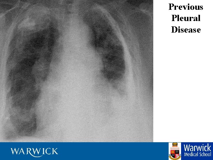 Previous Pleural Disease 