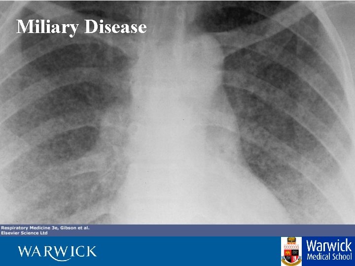 Miliary Disease 