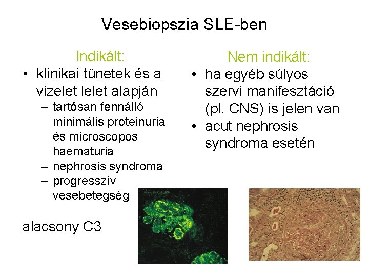 Vesebiopszia SLE-ben Indikált: • klinikai tünetek és a vizelet lelet alapján – tartósan fennálló