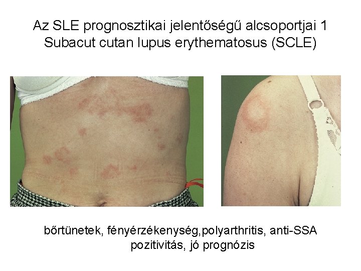Az SLE prognosztikai jelentőségű alcsoportjai 1 Subacut cutan lupus erythematosus (SCLE) bőrtünetek, fényérzékenység, polyarthritis,