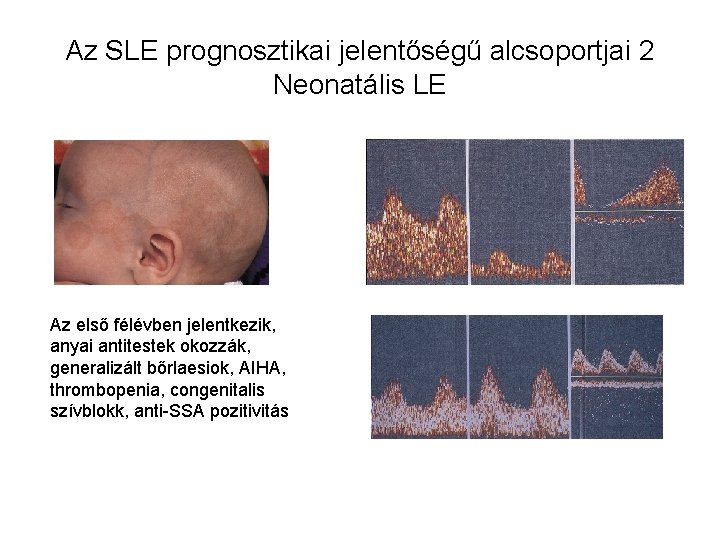 Az SLE prognosztikai jelentőségű alcsoportjai 2 Neonatális LE Az első félévben jelentkezik, anyai antitestek