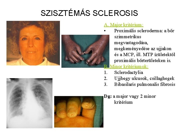 SZISZTÉMÁS SCLEROSIS A. Major kritérium: • Proximális scleroderma: a bőr szimmetrikus megvastagodása, megkeményedése az