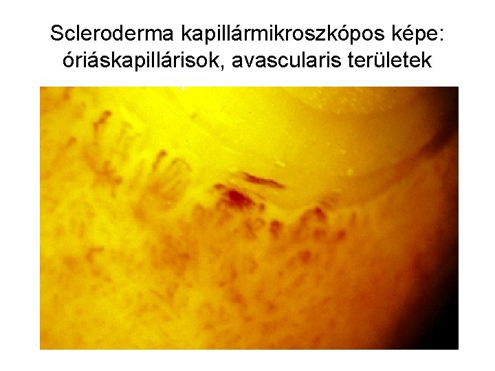 Scleroderma kapillármikroszkópos képe: óriáskapillárisok, avascularis területek 