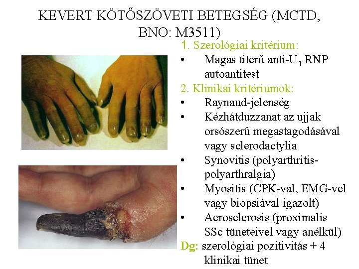 KEVERT KÖTŐSZÖVETI BETEGSÉG (MCTD, BNO: M 3511) 1. Szerológiai kritérium: • Magas titerű anti-U