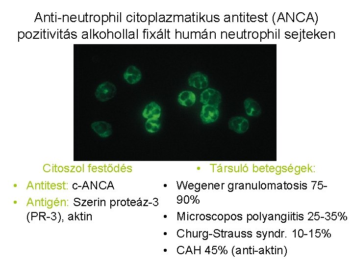 Anti-neutrophil citoplazmatikus antitest (ANCA) pozitivitás alkohollal fixált humán neutrophil sejteken Citoszol festődés • Társuló